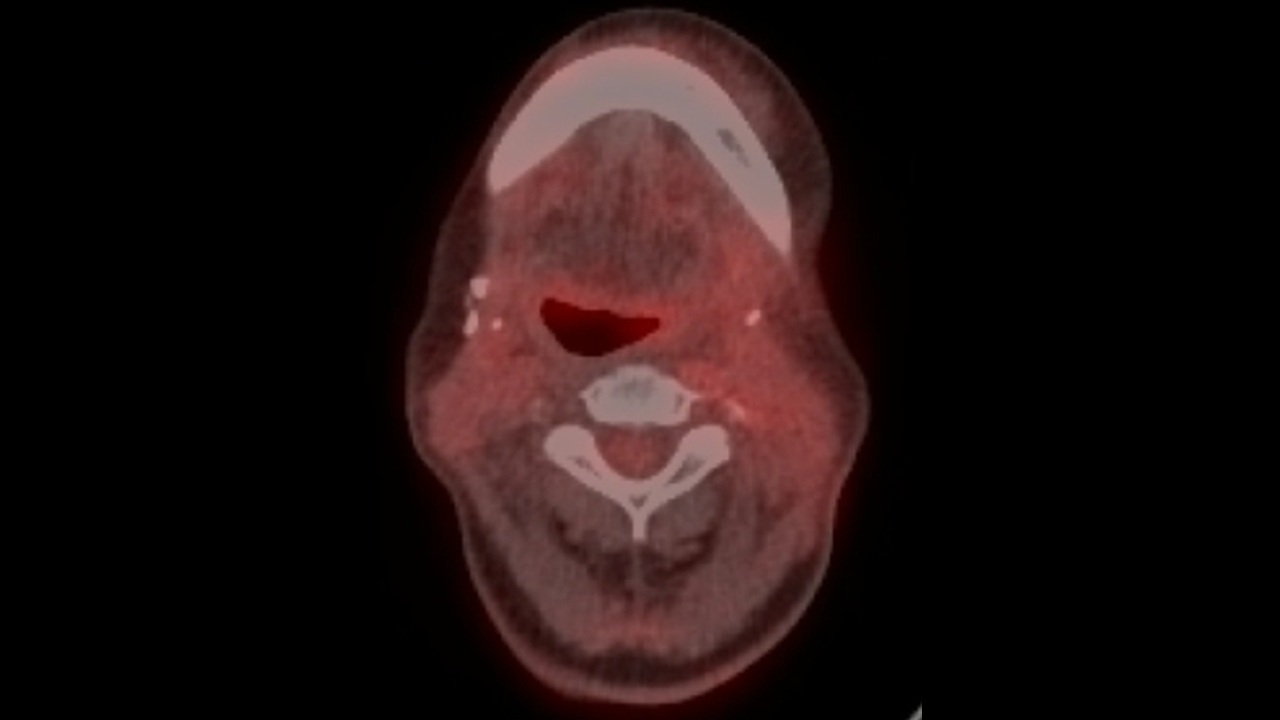 沒有標靶藥物抗藥性，後續免疫療法成效較佳。頭頸癌患者的正子攝影，可以見到沒有黃色亮部的腫瘤顯影