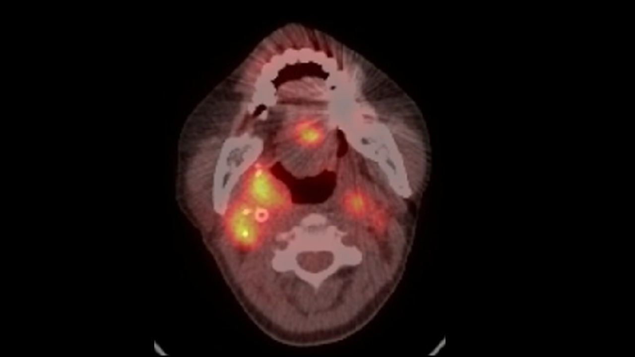 頭頸癌患者的正子攝影，黃色亮部為腫瘤顯影。圖中顯示長期標靶治療帶來的治療壓力，會讓癌細胞提高警覺，接續的免疫療法反而成效不如預期